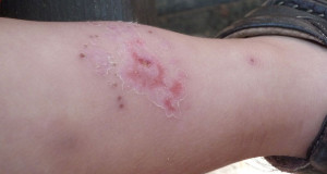 caz de impetigo la copii