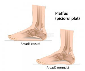 Platfus (piciorul plat). (sursa foto: romedic)